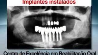 Implantes dentários com carga imediata [upl. by Hubbard]