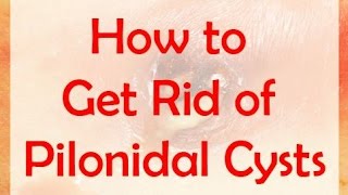 How to Get Rid of Pilonidal Cysts Fast at Home [upl. by Aisital860]