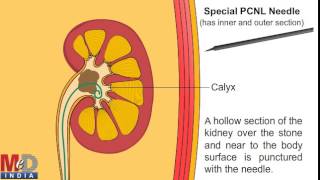 Percutaneous Nephrolithotomy [upl. by Ahsehat]