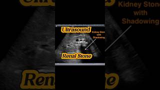 Renal Stones  Ureteric VUJ Stone  Hydronephrosis Hydroureter Ultrasound [upl. by Aihseyk]