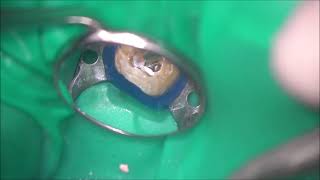 Sealer based obturation of 5 root canals using OneFil [upl. by Sollie]