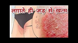 दाद खाज खुजली कितना भी साल पुराना हो 5 दिन में छुट्टी कर देगा  fungal ringworm treatment [upl. by Gnouhp]