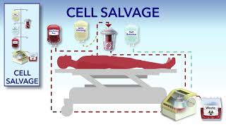 Cell Salvage and Hemodilution [upl. by Anegroeg534]