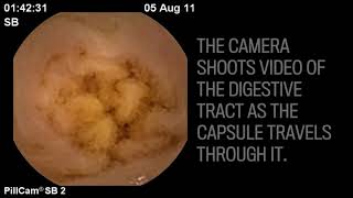 Capsule endoscopy A tiny wireless camera through the digestive tract [upl. by Parrish]