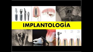 quotIMPLANTOLOGÍA INTEGRADAquot [upl. by Enahpets]