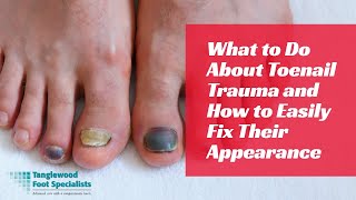 What to Do About Toenail Trauma and How to Easily Fix Their Appearance [upl. by Artemis771]