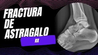 Fractura de astrágalo [upl. by Navac50]