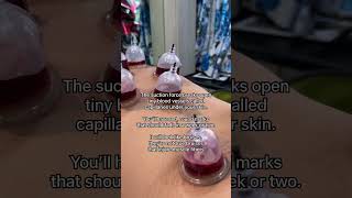 Hijama benefits in islam amp science [upl. by Froh917]