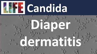 Candida diaper dermatitis part 13 [upl. by Nefets]