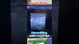 Plazmolifting muolajasi bo’g’imlarga super davo revmatolog doctor medical osteoartritis [upl. by Airoled]