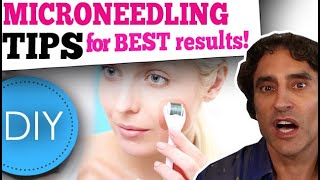 MICRONEEDLING DIY at HOME  What You Need to Know [upl. by Gainer]