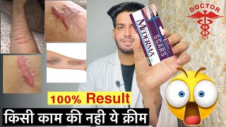 Mederma cream  Mederma advanced scar gel review  Mederma cream ke fayde  किसी काम की नही क्रीम 😱 [upl. by Hesoj233]