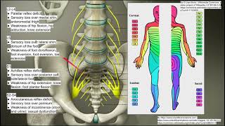 Lumbosacral radiculopathy [upl. by Nosauq]