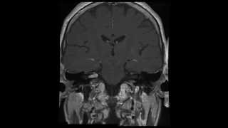 Acoustic neuroma vestibular schwannoma  Neurinoma do Acustico [upl. by Germann918]