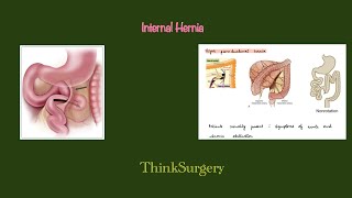 Internal Hernia Brief review with complete explanation [upl. by Hayman]