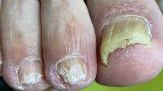 Limpieza UÑA con HONGOS y ENCARNADA  Fungal and ingrown toenail ingrowntoenail nails channel [upl. by Aneelahs594]