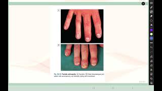 Rheumatology L5 Spondyloarthropathies p33 Psoriatic arthritis [upl. by Aramac]