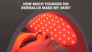 See what Dermalux Flex did for my skin  Alice HartDavis [upl. by Wellington]