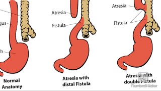 Tracheoesophageal Fistula  TEF and its types [upl. by Karlyn]