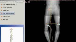 TraumaCad  High Tibial Osteotomy [upl. by Addiego]