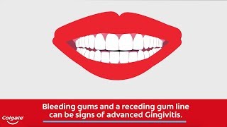 Bleeding Gums and the Signs of Gingivitis  Colgate® [upl. by Michelsen]