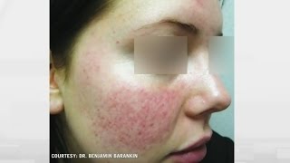 Rosacea relief How to treat persistent facial flushing [upl. by Hyacinthie391]