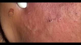 Relax Every Day acne pimplepopping blackheads [upl. by Akemat918]