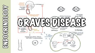 Graves Disease  Overview causes pathophysiology investigations and treatment [upl. by Piers591]