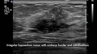 Breast ultrasound  cancer [upl. by Ennej]