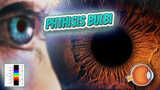 Phthisis bulbi  Your EYEBALLS  EYNTK 👁️👁️💉😳💊🔊💯✅ [upl. by Uok]