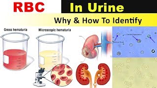 RBC In Urine  Why amp How to Identify [upl. by Hagood272]