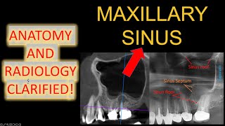 ALL Maxillary Sinus Anatomy 3D CBCT Mucosal Thickening in x ray OPG easy maxillary sinusitis lecture [upl. by Candida]