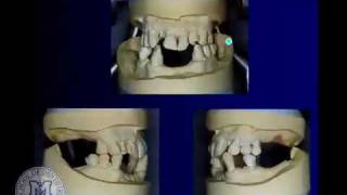 DENT 718 Tooth supported overdentures [upl. by Roxane878]