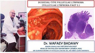 DUODENAL TYPE FOLLICULAR LYMPHOMA BY DR WAFAEY BADAWY [upl. by Acirem]