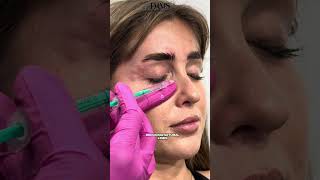 Full Face Botulinum Toxin Injection by Expert Doctor Prepare to Be Amazed [upl. by Phail290]