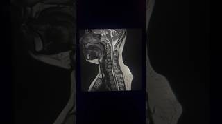 🤔Mri t2 cervical spine image c spine mriradiology viral mri shortsvideo shorts [upl. by Adnorrahs]