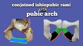 conjoined ishiopubic rami with pubic arch  lower limb of anatomy  Foziya Vohra amp Mukta Nivedita [upl. by Llekim659]