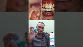 Chlorhexidine Gluconate Mouth Wash  treatment of bacterial Infection in mouth Payria mouth Ulcer [upl. by Ennirak]