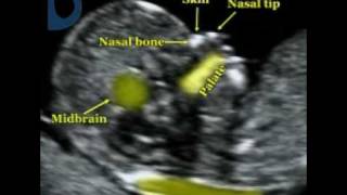 Fetal Medicine Foundation  Fetal profile [upl. by Legnaesoj303]