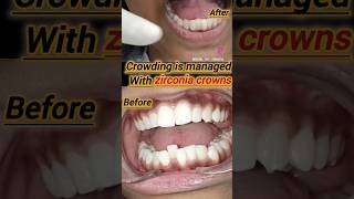 Crowding of teeth can be managed without braces also smilemakeover [upl. by Kimberli319]