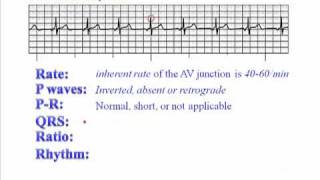 ECG Junctional Rhythm [upl. by Kania]