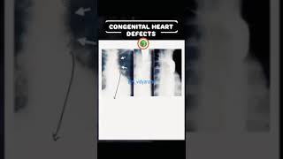 XRAY CHEST CONGENITAL HEART DEFECTS chest xray appa view doctor trending viral video [upl. by Lalat]