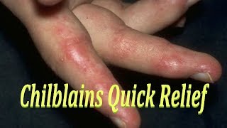 CHILBLAINS QUICK RELIEF  EASY HOME REMEDY FOR CHILBLAINS  CURE FOR बिवाई PERNIOSIS [upl. by Vorster126]