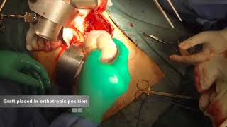 Orthotopic Kidney Transplantation [upl. by Demmahom479]