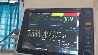 Tachypnoea in severe mitral stenosis with atrial fibrillation and fast ventricular rate [upl. by Nesahc]