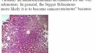 Adenocarcinoma Prognosis [upl. by Bradman]