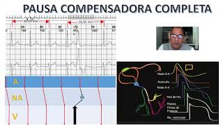 🅿🅰🆄🆂🅰 compensadora 🅲🅾🅼🅿🅻🅴🆃🅰 en extrasístole Ventricular Análisis del Ekg mecanismo y Escaleligrama [upl. by Ahsad]