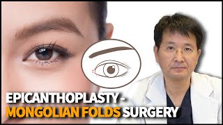 Epicanthoplasty  Eye Surgery that modifies the Epicanthal Folds [upl. by Mccutcheon333]