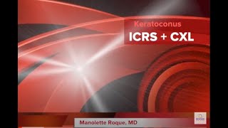 Keratoconus  Keraring ICRS  Corneal Collagen CrossLinking CXL [upl. by Ngo]