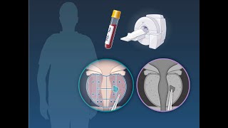 PSA and MRI Prostate Cancer Screening  NEJM [upl. by Iz]